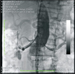 – Angiography showing coated stent placement and aortic endoprosthesis.