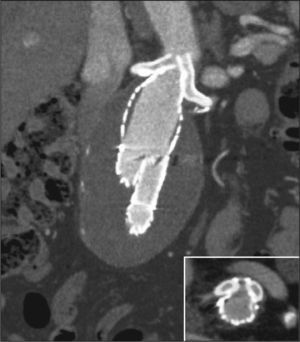 – CT angiography of the abdominal aorta in coronal section, showing adequate coupling between the endoprosthesis and the coated stent. Patent renal arteries. In the detail, axial section showing absence of leaks.