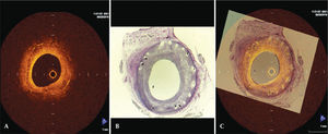 – Cross-sections of porcine coronary artery with drug-eluting stent. (A) Optical coherence tomography; (B) Histological analysis; (C) overlapping images, aiming to choose the cross-section of optical coherence tomography analogous to the histological picture.