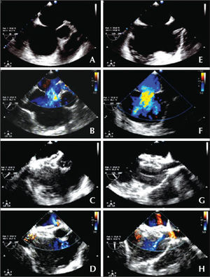 – Atrial septal defect of 16mm without aortic border: short axis (A, B, C and D) and Bicaval or long axis (E, F, G and H). (A and E) Diameter of the defect. (B and F) Left-right flow in color Doppler. (C and G) Adequate positioning of the prosthesis, embracing the aorta in the short axis and the borders of both cavas in the long axis. (D and H) No residual flow.