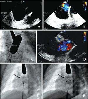 – Atrial septal defect (ASD) with no aortic border. (A) Echocardiogram in the short axis. (B) Color Doppler showing left-right flow. (C) Measuring balloon with discreet waist, determining an ASD diameter of 19.5mm. (D) Color Doppler with the implanted device and the absence of residual flow. (E and F) Fluoroscopy in the left anterior oblique view of the implanted prosthesis, still attached to the delivery cable and under mild tension (C), and released prosthesis showing a more vertical position (D). The arrows show the greater separation of the disks at the top, where the prosthesis embraces the aorta.