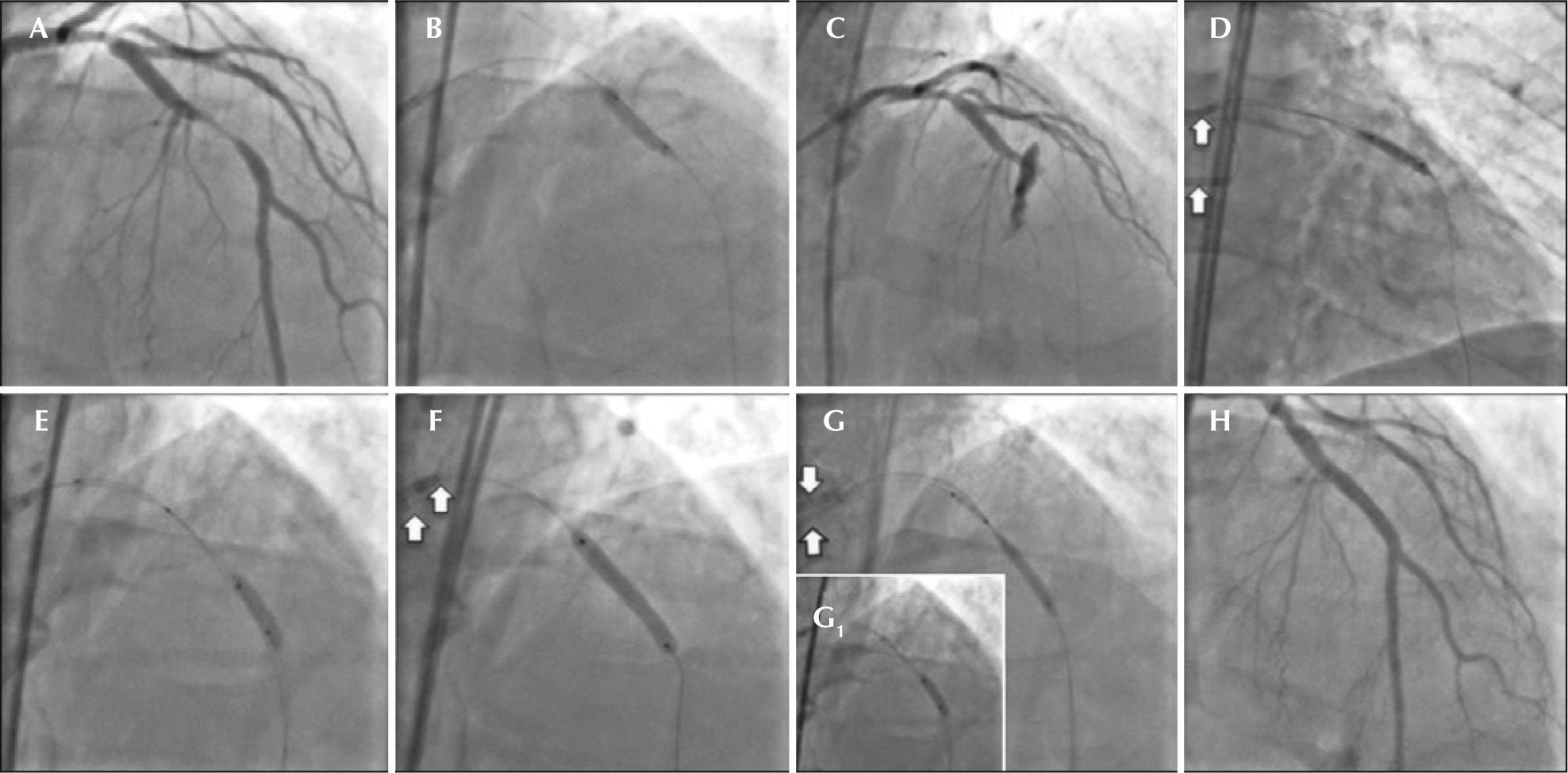 Treatment with the Double Guiding Catheter Technique for Type III ...