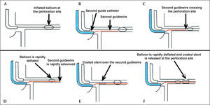 – Schematic diagram showing the double guide-catheter technique. (A) Balloon used in the angioplasty inflated at low pressure (4 atm) at the perforation site. (B) Careful withdrawal of the first guide-catheter and catheterization of the coronary ostium with the second guide-catheter. (C and D). Advancement of the second guide-catheter, crossing the perforation site with quick balloon deflation, allowing its passage. (E) Coated stent advancing over the second guide catheter. (F). Rapid deflation maneuver, balloon withdrawal and coated stent implantation at the perforation site.