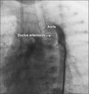– Aortography disclosing “vertical” ductus arteriosus (arrooriginating in the proximal portion of the aortic arch.