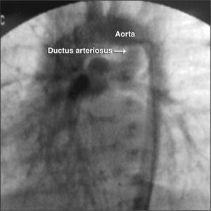 – Aortography disclosing a well implanted and expanded stent (arrow) in the ductus arteriosus.