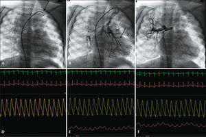 – Pulmonary atresia with ventricular septal defect type C (Barbero-Marcial). (A) Selective catheterization of bifurcated collateral with origin in the left subclavian, with pressure-wire in position of pressure equalization. (B) Pressure-wire in the left pulmonary artery branch through the most stenotic sub-branch of the collateral vessel. (C) Collateral toward the right lung, upper lobe. (D) Pressure equalization. (E) Intravascular pressure in the left pulmonary artery branch, inferior lobe, with a mean of 18mmHg. (F) Intravascular pressure in a branch to the upper lobe of the right lung, with a mean of 21mmHg.