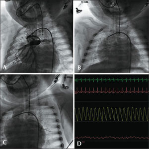 – Patient with pulmonary atresia with ventricular septal defect undergoing a modified Blalock-Taussig shunt. (A) Pulmonary arteriography with injection through Blalock-Taussig shunt. (B) Pressure-wire positioned through the GORE-TEX® tube in the right pulmonary artery branch. (C) Pressure-wire into the left pulmonary artery branch. (D) Simultaneous aortic and pulmonary pressure curves, with mean pulmonary intravascular pressure of 11mmHg in both branches.