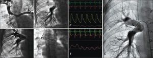 – Pre-Fontan catheterization. (A) Bidirectional Glenn anastomosis with preferential flow to the left lung. (B) Selective angiography of the right pulmonary artery branch through the conduit in the Glenn procedure. (C) Aortic and left pulmonary artery branch pressures, on a scale of 100 (left branch of the pulmonary artery, 10mmHg). (D) Systemic-pulmonary collateral to the right upper lobe. (E) Pressure-wire into the collateral vessel. (F) Intravascular pressure into the right pulmonary artery branch obtained with the pressure-wire (mean of 14mmHg) on scale of 25mmHg. (G) Angiography with Berman catheter occluding the collateral vessel, showing the whole irrigation of the right lung via pulmonary artery.