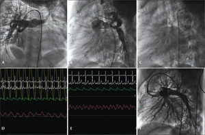 – Patient with two central shunts with increased pulmonary blood flow and stenosis of the left branch. (A) A modified Blalock-Taussig shunt. (B) Conventional Blalock-Taussig shunt. (C) Pressure-wire into the left pulmonary artery branch. (D) Manometry of right pulmonary artery branch with an MP 5F catheter (mean pressure of 25mmHg on a scale of 50mmHg). (E) Manometry of distal branch of the left pulmonary artery (mean pressure of 17mmHg on a scale of 25mmHg). (F) Stent implantation into the left pulmonary artery branch with occlusion of the Blalock-Taussig shunt.