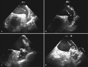 – Transesophageal echocardiography images. (A) Left atrial appendage with large thrombus inside, affecting the edge of the left superior pulmonary vein (arrow). (B) Left atrial appendage after 55 days of anticoagulation, showing thrombus resolution and measurement of the inlet orifice. (C) Device adequately deployed without residual shunt. (D) Presence of thrombus located in the prosthesis, above the site of the release system connection, visualized 72 days after the procedure (arrow).