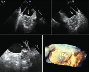 – Transesophageal echocardiogram images after anticoagulation for 30 days. Left atrial appendage 116 days after the procedure, showinsignificant reduction in thrombotic burden (arrows).