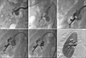 – Step-by-step remodeling technique for treatment of the type II renal artery aneurysm with 4F catheter. (A) Arteriography of the right renal artery. (B) Incidence used to visualize the distal main renal artery. (C) Balloon-expandable-stent implant in the aneurysm neck. (D) Catheterization of the aneurysmal sac with 4F JR catheter within the stent mesh. (E) Release of 0.035 coils in the aneurysmal sac. (F) Final renal arteriography.
