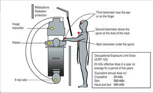 – Position of dosimeters to describe the exposure of staff during interventional procedures. The main personal dosimeter must be under the lead apron, at the level of the chest, directed towards the radiation source. The second dosimeter can be located above the apron at the level of the neck, and the third close to the eye or hand.