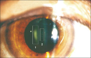 – Radio-induced crystalline lens opacity in an interventional radiology specialist submitted to high levels of radiation spread using a non-optimized angiographer with an X-ray tube above the table. Region 1 indicates posterior subcapsular opacity; region 2, perinuclear punctate opacities.