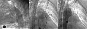 – Angiography in the right oblique view showing passage of the contrast to the pulmonary artery through the ductus arteriosus (A). Opening of the left disk in the aortic ampulla (B). Control angiography in right oblique view, posterior to the implant, showing correct device position without residual shunt (C).