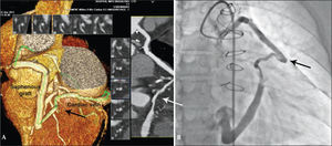 – Case 1: CT angiography demonstrating patent and dilated saphenous vein graft, connected to the great cardiac vein (arrow) in the left anterior oblique view (A) and angiography of the same graft in the right anterior oblique view (B).