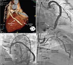 – Case 2: Angiography demonstrating saphenous-cardiac vein anastomosis (A). Angiography showing the two branches of the Y graft, radialleft anterior descending and saphenous-cardiac vein (B). Immediate outcome with ample flow after plug release, which can be seen by the proximal and distal marks (C). Outcome after 30 days of procedure, showing the better positioned plug and occlusion of the branch to the cardiac vein, in addition to permeability of Y to left anterior descending artery (D).