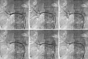 Sequential radiofrequency applications initiated in the distal segment of the right renal artery. The catheter is pulled and rotated after each application, with the aim of promoting sequential lesions in a helical configuration (A to E).