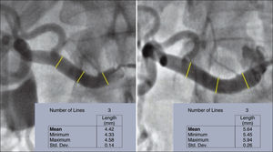 Quantitative angiography at right renal artery. Left, before percutaneous renal sympathetic denervation with a mean of proximal/middle third/distal diameters of 4.42mm. Right, 6 months after the procedure, showing increase in mean diameters to 5.64mm.