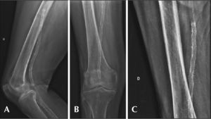 (A) Radiography of knee in semi-flexion, with no signs of stent twisting or fracture. (B) Radiography of knee in posteroanterior view and with no signs of fracture. (C) Radiography of knee without evidence of compression at the level of adductor canal.