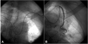 Opacification of internal mammary artery through the contralateral radial access. (A) 260cm - long, 0.35-inch guidewire positioned in the left subclavian artery. (B) Selective cannulation of left internal mammary artery with a mammary guide catheter.