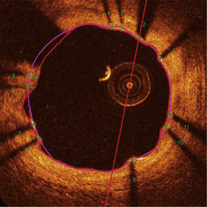 Optical coherence tomography analysis. The luminal contour is segmented automatically, following the border between the lumen and the intimal layer (red line). Then the stent struts – highly light-reflective structures, with dorsal shade – are identified by an automated algorithm. The points located on the luminal surface are connected to determine the stent area (pink line). The distances between the luminal surface of each strut to the luminal contour are automatically determined by a trajectory directed towards the center of the vessel (green lines).