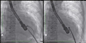 (A) Deflectable sheath positioned toward a left ventricular pseudoaneurysm, with catheter and its extra-rigid guide positioned within the defect. (B) First disc of the device disc released within the defect through the deflectable sheath.
