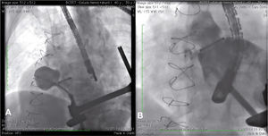 (A) Angiography with catheter inside the left ventricular pseudoaneurysm, close to the aortic prosthesis, showing the defect anatomy. (B) Ventriculography after device implantation, with mild residual shunt through the device.
