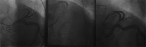 Percutaneous coronary intervention in the second branch of left anterior descending artery (arrow).