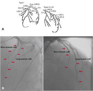 Spindola-Franco diagram showing a type I dual left anterior descending artery (A). Left coronary artery in left and right anterior oblique projections (B). LAD: left anterior descending artery. Source: Spindola-Franco et al.1