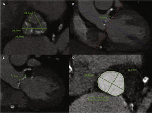 Multidetector computed tomography analysis of the aortic valvar complex. (A) Sinuses of Valsalva dimensions. (B) Left main coronary artery height, measured perpendicular from aortic annulus. (C) Left leaflet length. (D) Aortic annulus measurements (area, perimeter, maximal, and minimal diameters).