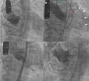 Fluoroscopic images of a coronary protection case. (A) Aortogram in a coplanar view demonstrating the three aligned aortic valve cusps, and the low origin of the left main coronary artery. (B) Balloon aortic valvuloplasty. The guiding catheter is pulled into the ascending aorta (green arrow). Note the undeployed stent (red arrow) and the coronary wire (white arrows). (C) Balloon-expandable valve in position prior to implantation. (D) Aortogram after valve deployment, demonstrating good position, without evidence of coronary obstruction.