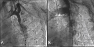 Descending aortography in the left projection. In (A), there is a gradual reduction in the aorta diameter, from the origin of the left subclavian artery, ending in the focal coarcted area at the end of the aortic isthmus (tubular hypoplasia). Note the post-stenotic dilation of the descending aorta. In (B), severe segmental coarctation is observed, encompassing the entire aortic isthmus. The reduced caliber of the descending aorta can be observed, which does not present the usual post-stenotic dilation.