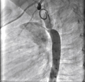 Descending aortography in the left projection shows focal coarctation at the end of aortic isthmus and additionally, the presence of type A patent ductus arteriosus, resulting in opacification of the pulmonary trunk.