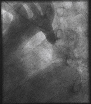 Aortography in caudal left anterior oblique projection, showing a very constricted coarctation, considered to be subatretic.