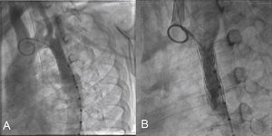 In (A), descending aortography immediately after the first implant (Case 3) showing the well-positioned stent with good flow. In (B), control aortography 5 years after implantation, showing luminal reduction by intimal proliferation along the entire stent length.