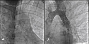 In (A), detail of the Advanta covered stent disclosing collapse of his upper border, with partial lumen obstruction. In (B), recovery of aortic lumen after implantation of a Cheatham Platinum uncovered stent.