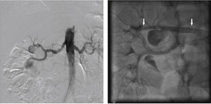 Digital subtraction aortography and final renal angiography after multilayer stenting. On the left, abdominal aortogram showing bilateral renal fibrodysplasia with a massive right renal artery aneurysm. On the right, final arteriography after multilayer stenting. The arrows point to the beginning and the end of the stent.