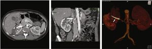 Postoperative computed tomography angiography of the treatment of the right renal artery aneurysm. On the left, the arrow indicates a hypodense region in the right renal parenchyma devoid of vascularization, compatible with renal ischemic infarction. In the middle panel, the arrow indicates preservation of a renal segmental branch from the multilayer stent. On the right, three-dimensional volumetric reconstruction of abdominal aorta and renal arteries. The arrow indicates the position of the multilayer stent in the renal artery.