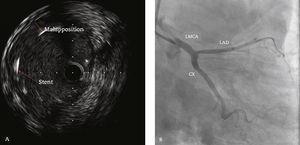 Intravascular ultrasound performed after stent implantation in the left main coronary artery (LMCA) showing image suggestive of stent strut malapposition (A). Coronary angiography (right anterior oblique caudal projection) after the 4.0 x 28mm drug-eluting stent implantation in the LMCA, followed by post-dilation with a 4.5 x 15mm non-compliant balloon catheter (B). LAD: left anterior descending artery; CX: circumflex artery.