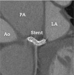 Coronary computed tomography angiography performed 8 months after the percutaneous procedure. The image shows the stent implanted in the left main coronary artery with no signs of extrinsic compression by the main pulmonary artery (PA). Ao: aorta; LA: left atrium.