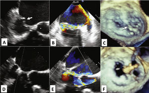 Transesophageal echocardiography pre- (A, B, and C) and post-procedure (D, E, and F). Note the coaptation gap between the cusps (A, arrow) due to prolapse of segments P2 and P3, and chordae tendineae rupture in P2 (C, arrow) causing eccentric anterolateral regurgitation (B). After MitraClipTM implantation in the medial border of P2 (D and F), there was significant reduction of regurgitation (E) and formation of double mitral orifice, with the characteristic “8” image in the three-dimensional echocardiography (F).