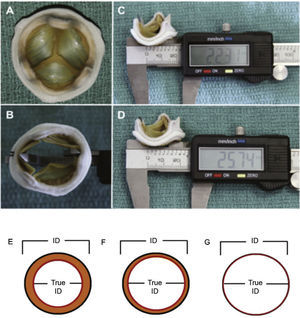 (A) Surgical bioprosthesis with porcine leaflets. (B) Measurement of the bioprosthesis internal diameter using a caliper. (C) Subtle distortion of the valve caused by the caliper, which can lead to incorrect measurements. First measurement: 22.31mm. (D) Second measurement: 25.74mm, showing the effect caused by the distortion. (E) Porcine valves: true internal diameter (ID) is at least 2mm less than the stent ID. (F) Pericardial valves with leaflets sutured inside the stent frame: true ID is at least 1mm less than the stent ID. (G) Pericardial valves with leaflets sutured outside the stent frame: true ID is the same as the stent ID. Adapted from Bapat et al.23