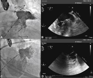 Correspondence between angiographic and echocardiographic images. In A, the left atrial appendage seen in the cranial-right anterior oblique view shows similarity with the echocardiographic image obtained with the transducer at 55° in B. In C, appendage angiography in the right anterior oblique view with caudal angulation shows a better depiction of the more terminal trabecular portion of the left atrial appendage, which is also seen in D in the echocardiographic image at 132°.