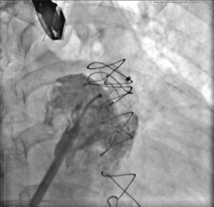 Angiography performed through the sheath system showing the disk inside the left atrial appendage and complete obliteration of the ostium by the prosthesis disc still attached to the delivery system, which would allow its repositioning if necessary.