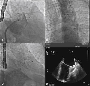 Images from case 5. In A, the accessory lobe occluded with the AMPLATZER® 16-mm Cardiac Plug and the appendage body occluded with AMPLATZER® 25-mm PFO Occluder can be observed. In B, the AMPLATZER® PFO Occluder is embolized into the aortic arch, being captured by the loop catheter. In C, at the end of the final procedure, the accessory lobe is completely occluded by AMPLATZER® 16-mm Cardiac Plug and the body of the left atrial appendage by the second AMPLATZER® 28-mm Cardiac Plug device. In D, echocardiographic control image after the procedure, showing the ostium of the left atrial appendage occluded by AMPLATZER® 28-mm Cardiac Plug device. Observe the increase in echocardiographic density in the left atrial appendage corresponding to AMPLATZER® 16-mm Cardiac Plug device, which is barely visible in this image.