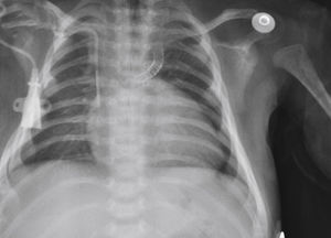 Front chest control X-ray on the fifth day after ductal stent implantation in a case of pulmonary atresia and interventricular communication.