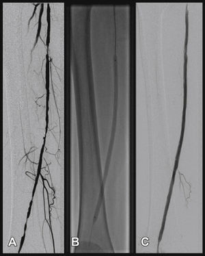Angioplasty with stent placement of the superficial femoral artery. In A, lesion in the proximal, middle, and distal segments of the superficial femoral artery. In B, post-dilation with balloon angioplasty. In C, the final arteriographic outcome.