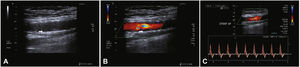 Doppler vascular ultrasonography. In A, stent assessment in B-mode. In B, color flow assessment. In C, spectral analysis of in-stent flow.
