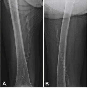 Thigh X-ray. In A, X-ray in the anteroposterior view without stent fracture signs. In B, X-ray in the right lateral view, without stent fracture signs.